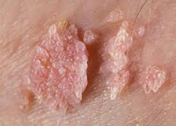 Бородавки от СОЖ